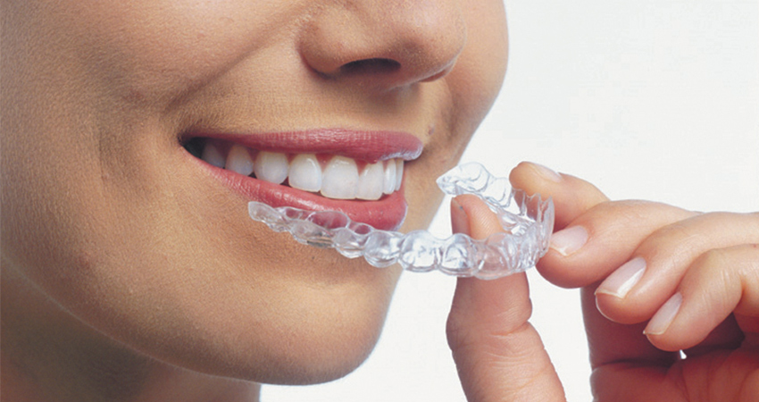 close up of a woman putting an Invisalign clear aligner on her top teeth
