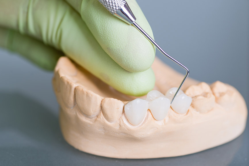 Featured image for “Dental Fixed Bridge Vs. Removable Bridge: Pros And Cons”